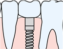 インプラントのイラスト